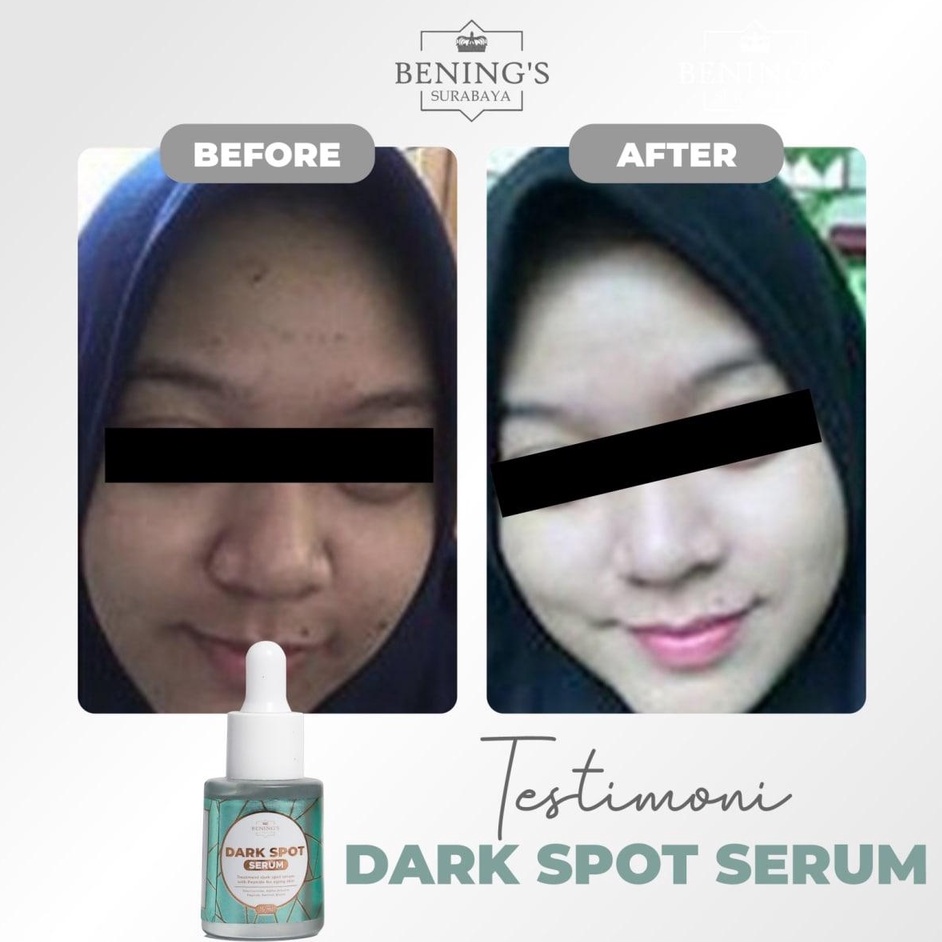 SERUM DARK SPOT BENING SKINCARE DR OKY PRATAMA  MENGATASI FLEK MELASMA MENCERAHKAN