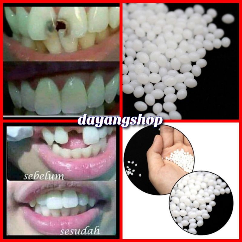 Temporary Tooth Penambal Gigi Butiran Berlubang Bolong Ompong Patah Jarang Renggang Keropos Depan Gi