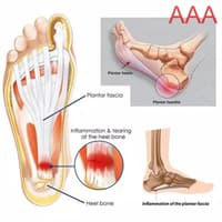 TBI Adjustable Plantar Fasciitis