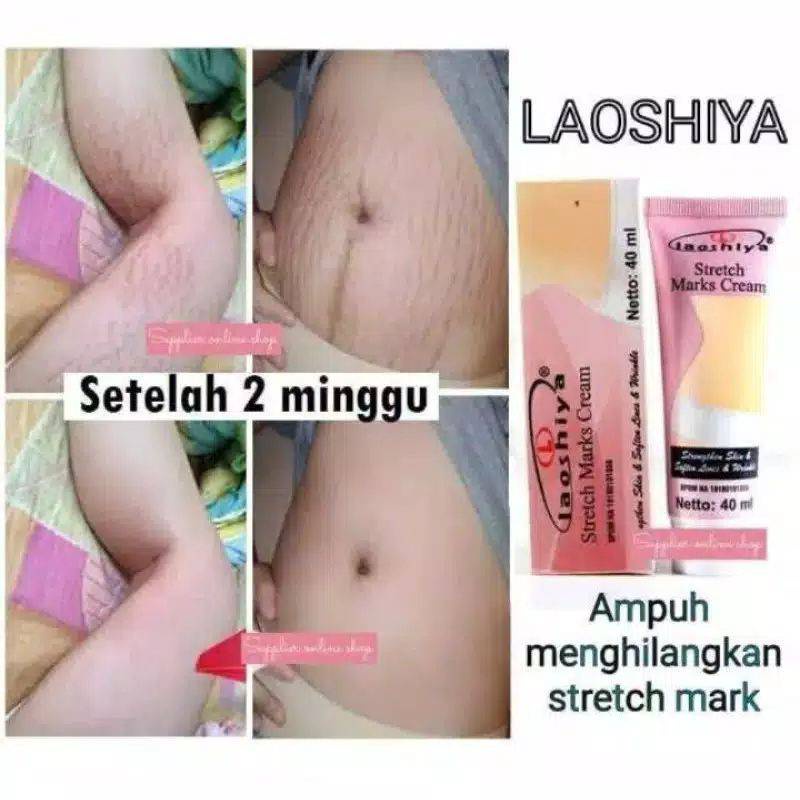 [COD] Krim Ampuh Penghilang Stretch Marks - Laoshiya Cream 40ml ORIGINAL BPOM Menyamarkan atau Menghilangkan Stretch Marks Garis Halus Pasca Melahirkan Penurunan serta Kenaikan Berat Badan