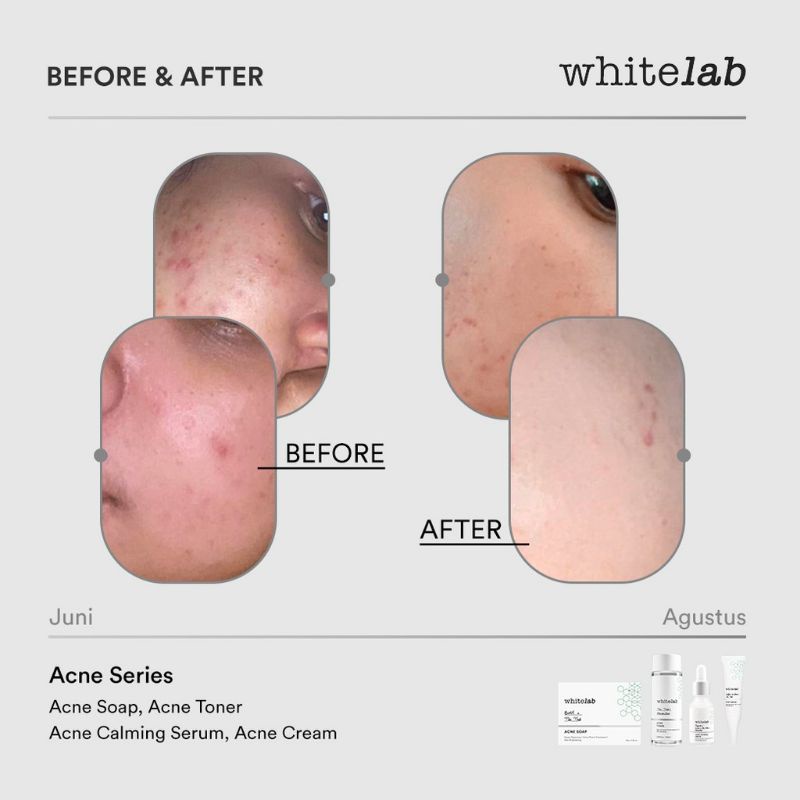 WHITELAB PAKET ACNE LENGKAP (Acne Calming Serum + Acne Soap + Acne Cream + Acne Toner)