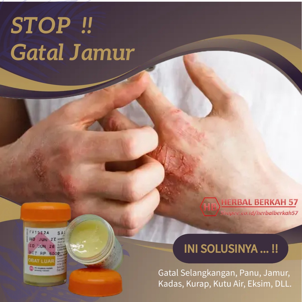 Salep Obat Gatal Eksim Kering Basah Menahun Paling Ampuh Kurap Kudis Selangkangan Jamur Kulit Gatel-6