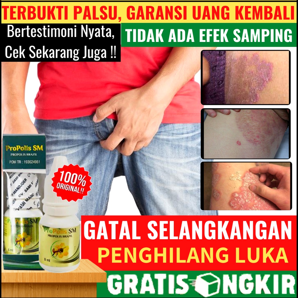 ProPolis SM Brazil Asli Obat Herbal Gatal Selangkangan Gatal Jamur Selangkangan Hitam Dan Gatal, Gat