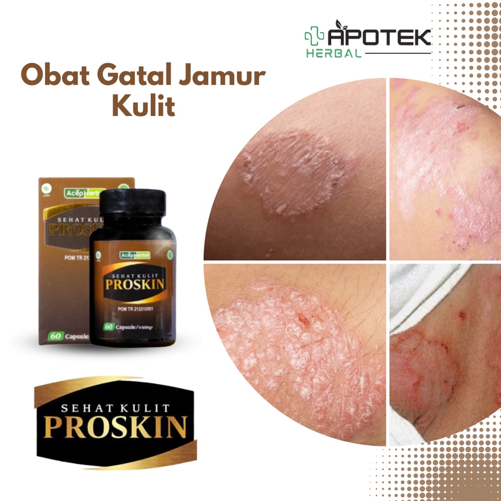 Obat Gatal Jamur Kulit, Obat Tinea Cruris, Obat Tinea Pedis, Obat Kandidiasis Kulit, Obat Gatal Kura