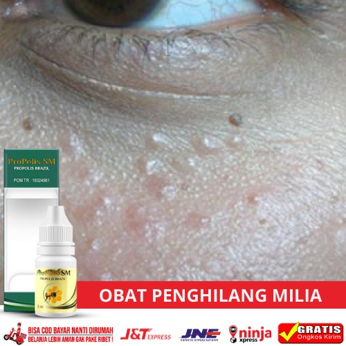 Obat Milia di Kelopak Mata/Penghilang Milia di Bawah Mata/Menghilangkan Milia di Kelopak Mata
