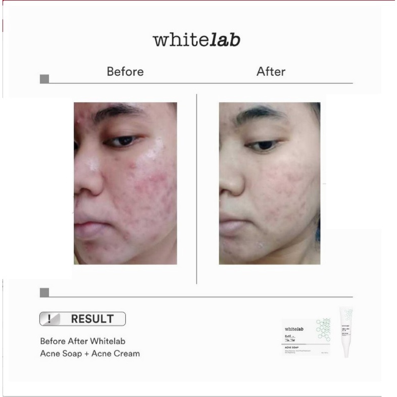 [BPOM] WhiteLab  Acne Soap 80 Gr (BHA + Tea Tree)