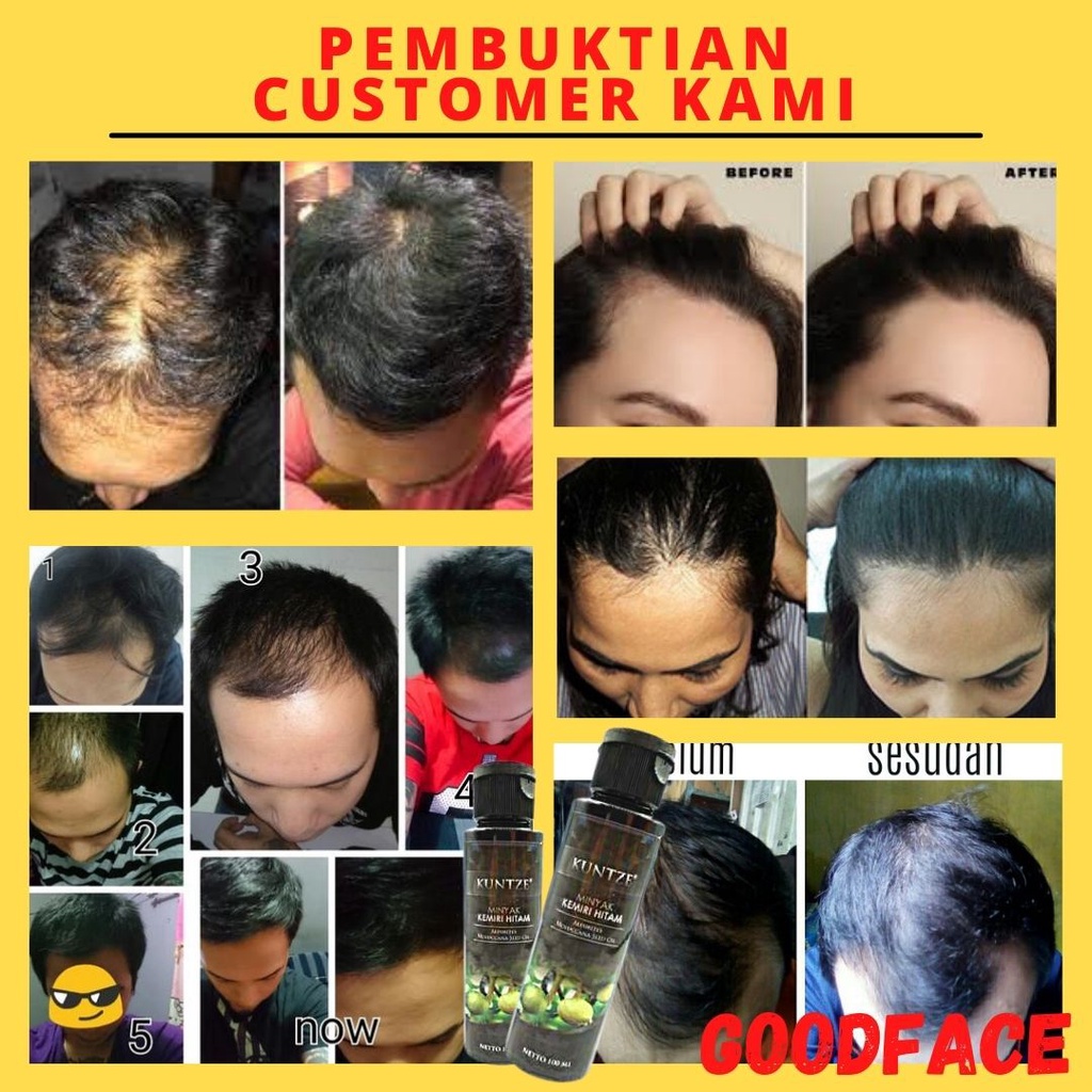 MINYAK KEMIRI HITAM KUNTZE ORIGINAL BPOM 100ML PENUMBUH RAMBUT BOTAK PENYUBUR RAMBUT PENGHITAM RAMBUT TREATMENT RAMBUT