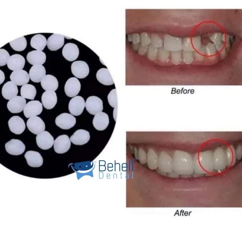TER MURAH !! 600 BUTIR TEMPTOOTH GIGI PALSU SEMENTARA PENAMBAL GIGI PATAH RENGGANG / TEMTOOTH / BAHAN TAMBAL GIGI BOLONG BERLUBANG / TEMPORARY TOOTH INSTAN PRAKTIS / TEMPTOOTH GINGSUL PATAH LEM ORIGINAL ISI 600 / 500 / 400 / 300 / 200 / 100 BUTIR