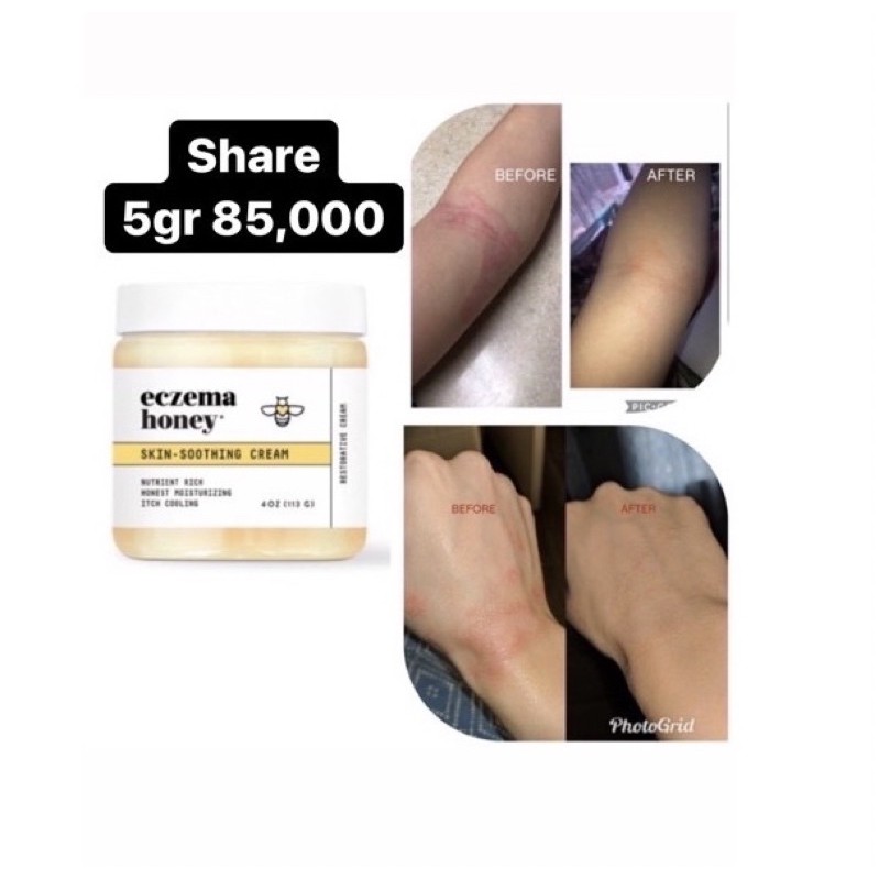 Eczema Honey Skin Soothing Cream (SHARE)