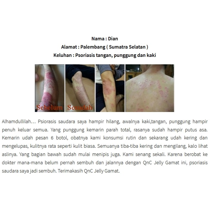 Obat Psoriasis Obat Kulit Gatal Bersisik Alergi Kulit Berkerak Qnc Jelly Gamat Indonesia