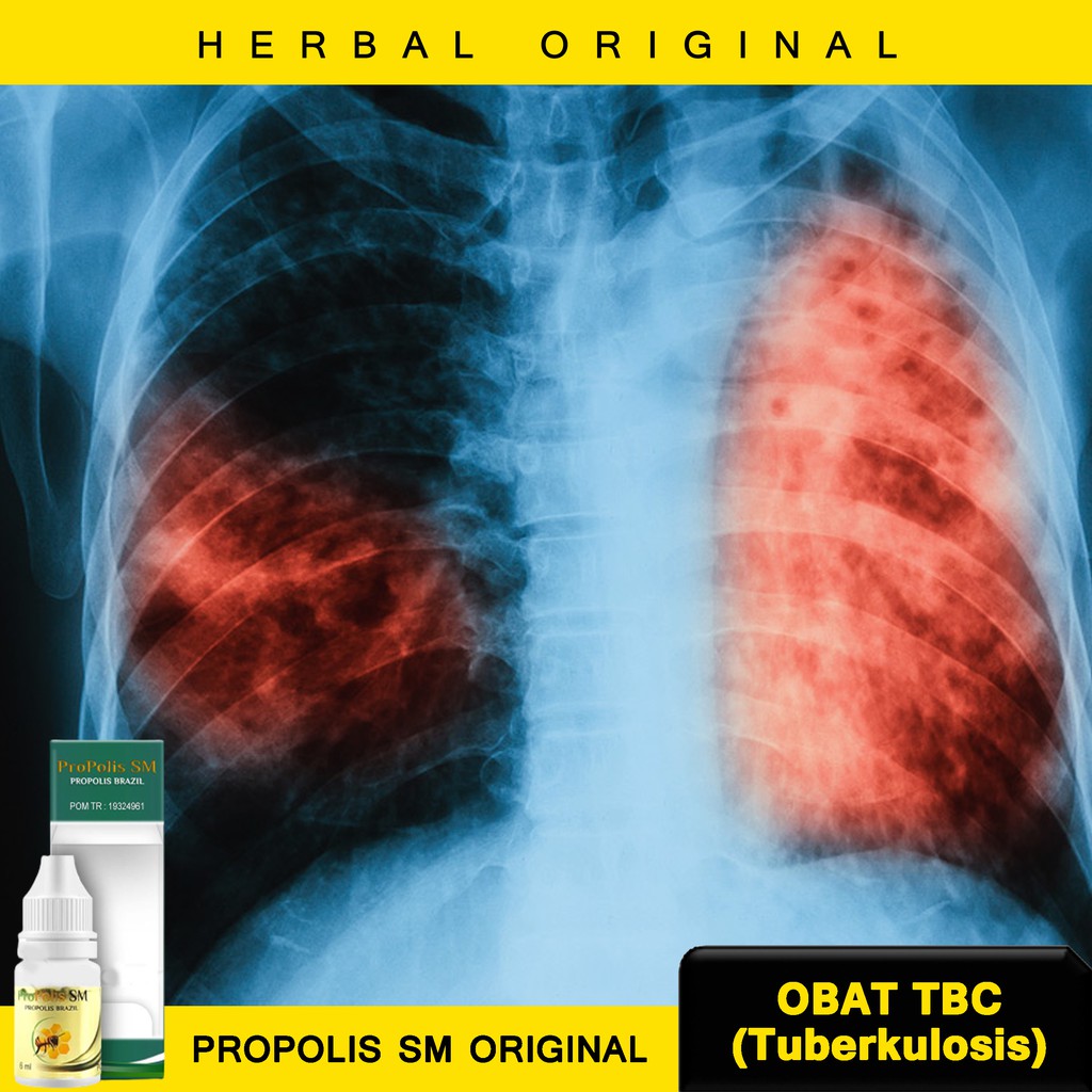 Obat TBC - Obat Tbc Paru - Obat Batuk Tbc - Obat Herbal Tbc Paru - Obat TBC Paru-Paru - Obat Herbal