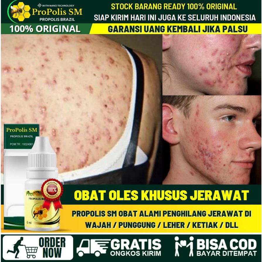 Obat Herbal Khusus Jerawat, Obat Oles Penghilang Jerawat di Wajah / Punggung / Leher / Kepala - Obat