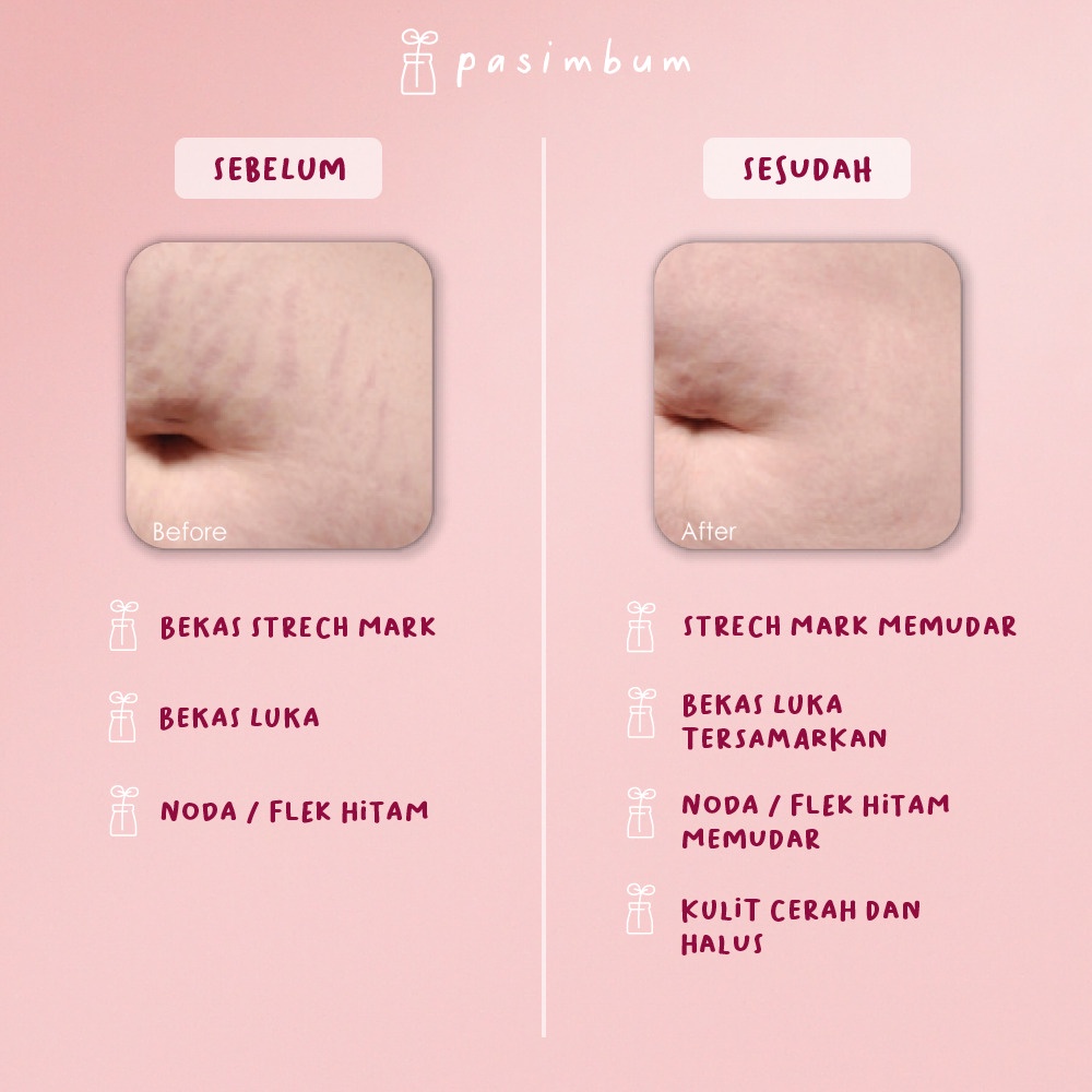 PASIMBUM Stretch Mark Cream - Penghilang Bekas Luka Operasi Selulit Keloid Strechmark