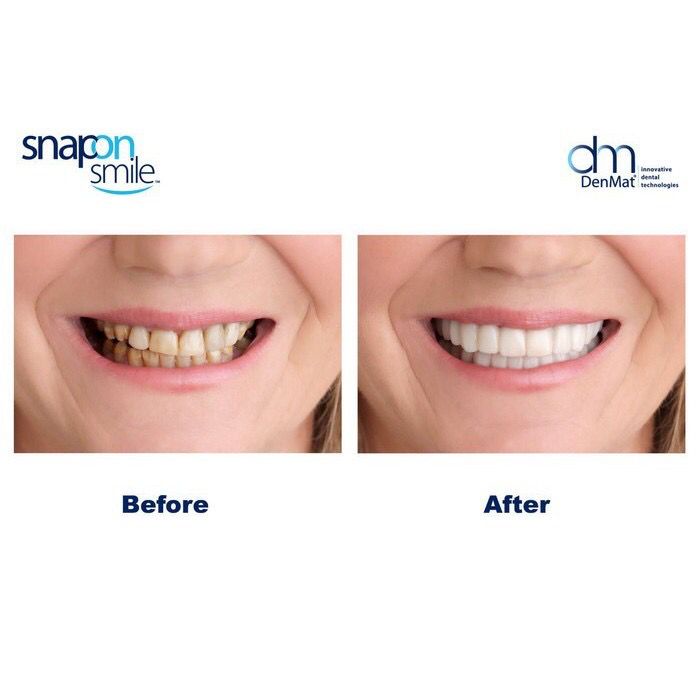 Snap On Smile 100% Original Authentic Gigi Palsu 1 Set Atas Bawah JAMINAN ORI BUKAN BARANG PALSU