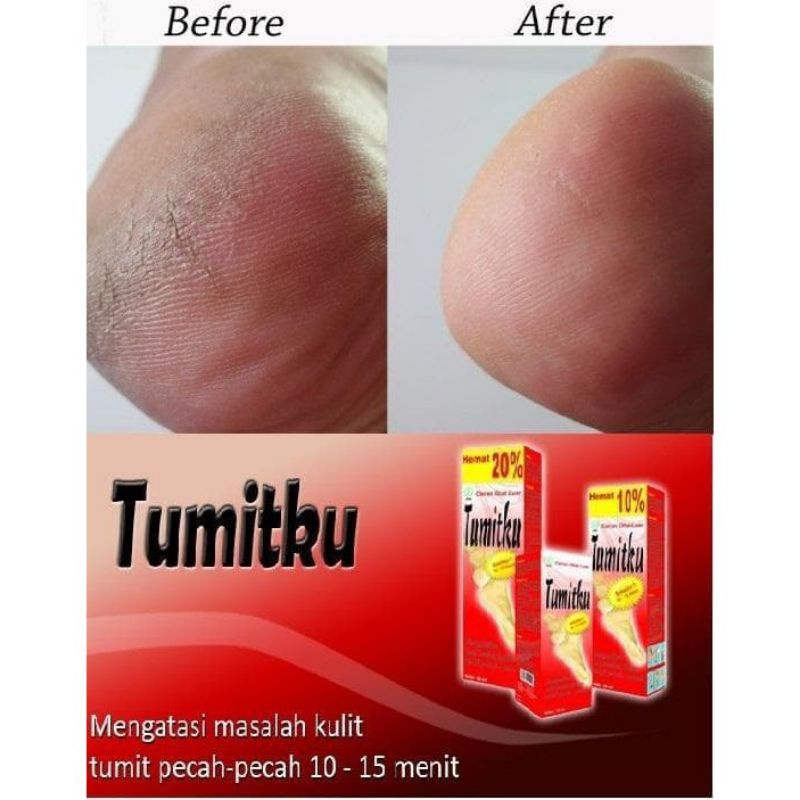 Tumitku mengatasi tumit pecah-pecah BPOM