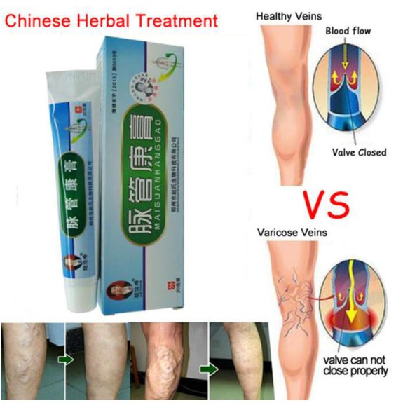 Salep Parises Herbal Varicose Veins Treatment