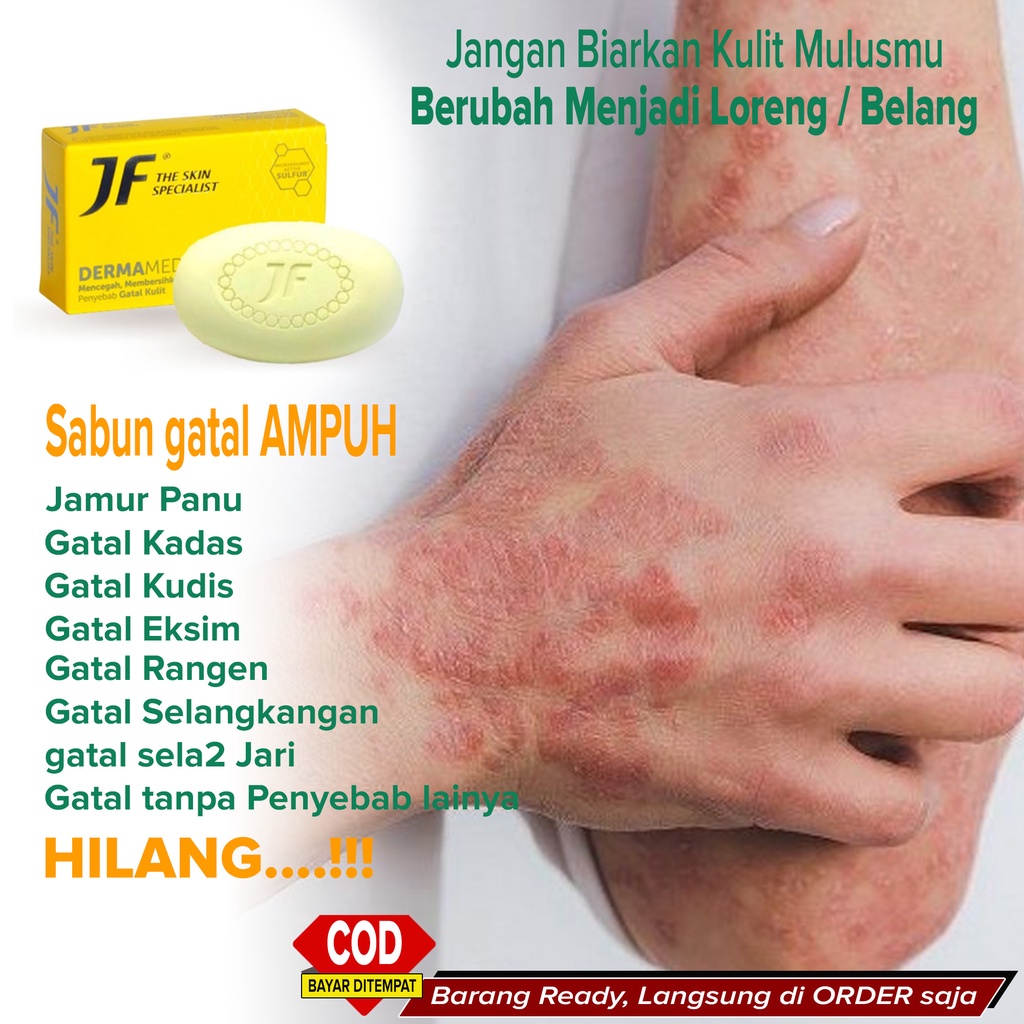 Sabun gatal jamur Panu Kadas Kudis eksim Kuman Kutu air Rangen dan gatal kulit tidak diketahui penye