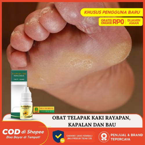 Obat untuk penyakit pitted keratolysis