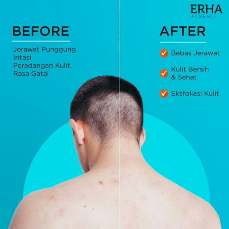 ERHA ACNE BACK SPRAY ORIGINAL - OBAT JERAWAT DI PUNGGUNG / BADAN BOTOL BESAR 100 ML