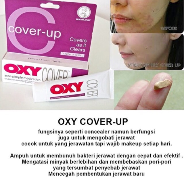 OXY COVER 25gr acne pimple medication ORIGINAL - Obat jerawat