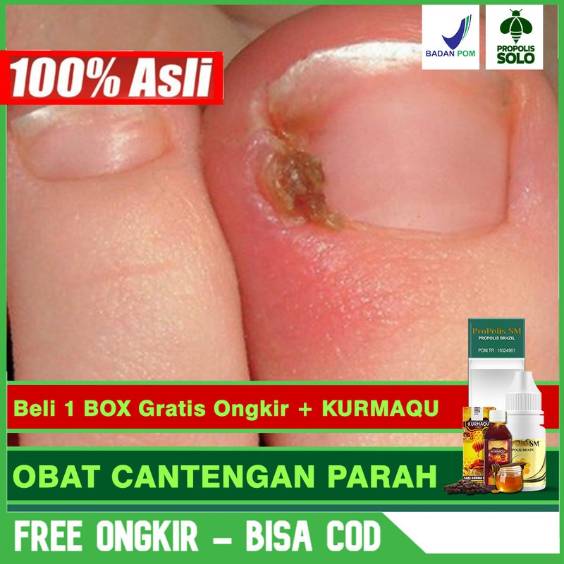 Jual Obat Cantengan Parah Sakit Dan Bengkak Jempol Kaki Tangan