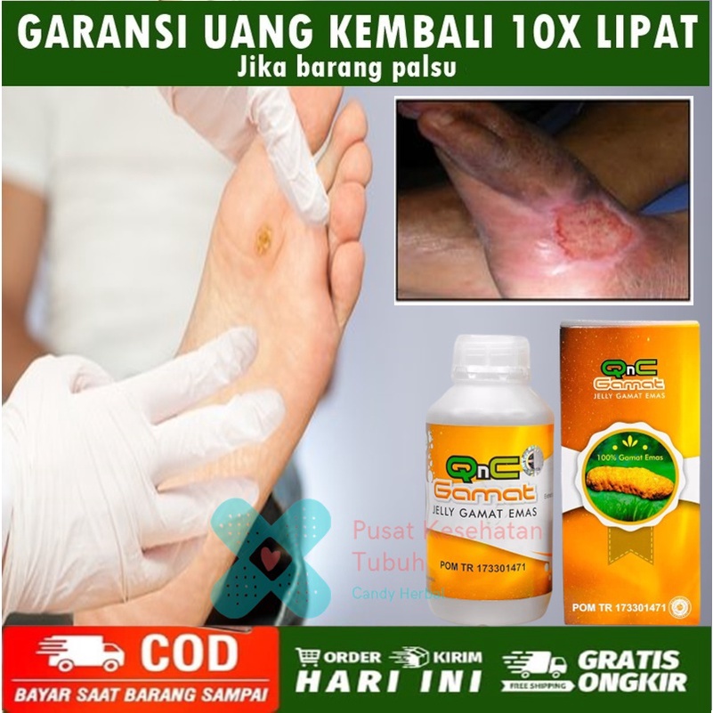 Obat herbal untuk penderita diabetes,Obat luka diabetes, obat diabet, obat gula diabetes, Luka Lecet