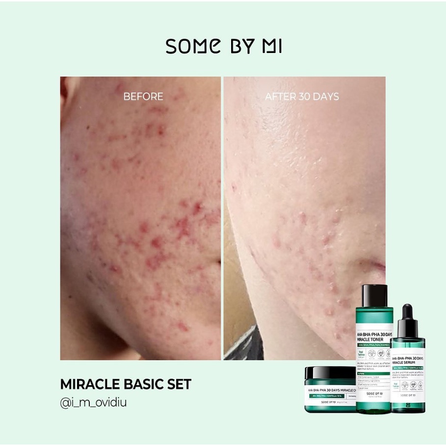 SOME BY MI Aha Bha Pha 30days Miracle Starter Kit Memperbaiki  Warna Kulit Wajah