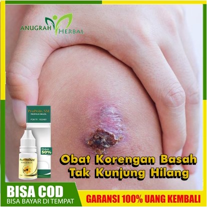 Obat Korengan Basah di Oles Kering, Herbal Penghilang Koreng Krusta, Prurigo, Ektima, Dermatitis