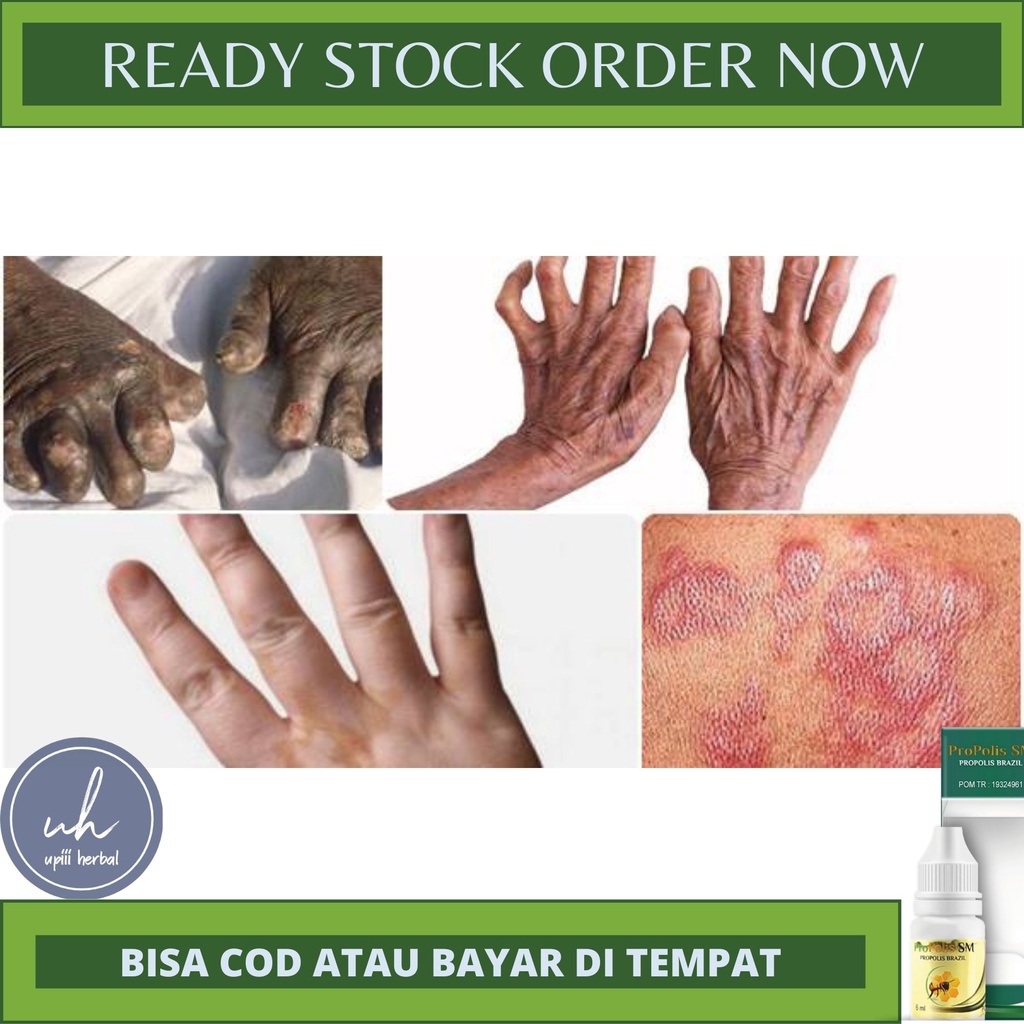 OBAT KUSTA/LEPRA, OBAT KUSTA BASAH, OBAT MULTI BASILER, OBAT KUSTA KERING, OBAT HERBAL KUSTA, OBAT L