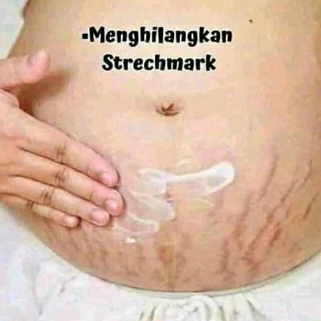 PENGHILANG STRECHMARK
