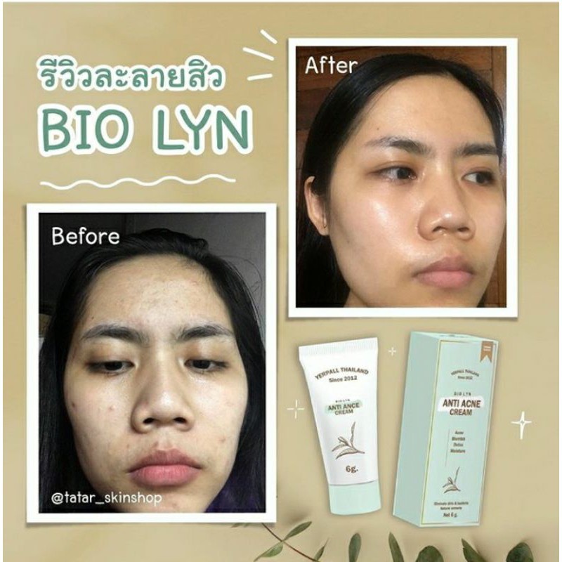 ANTI ACNE CREAM / BIO LYN / YERPALL by AILIN