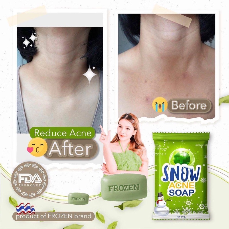 SABUN JERAWAT / ACNE SOAP / SABUN JERAWAT PUNGGUNG ORIGINAL 100%
