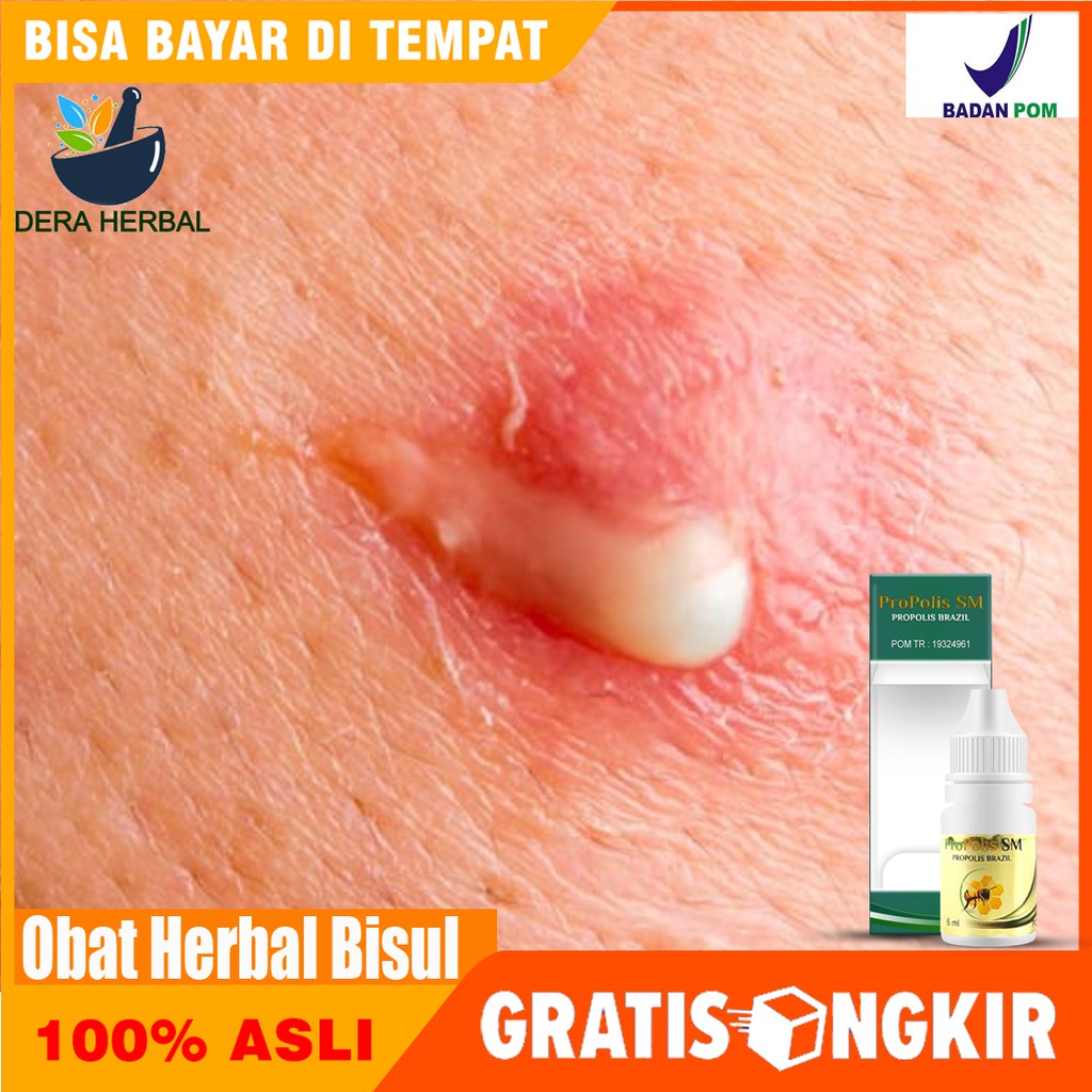 Obat Bisul - Obat Bisulan, Obat Benjolan Bernanah, Bisul Herbal, Bisul di Kemaluan - Proplis Sm COD