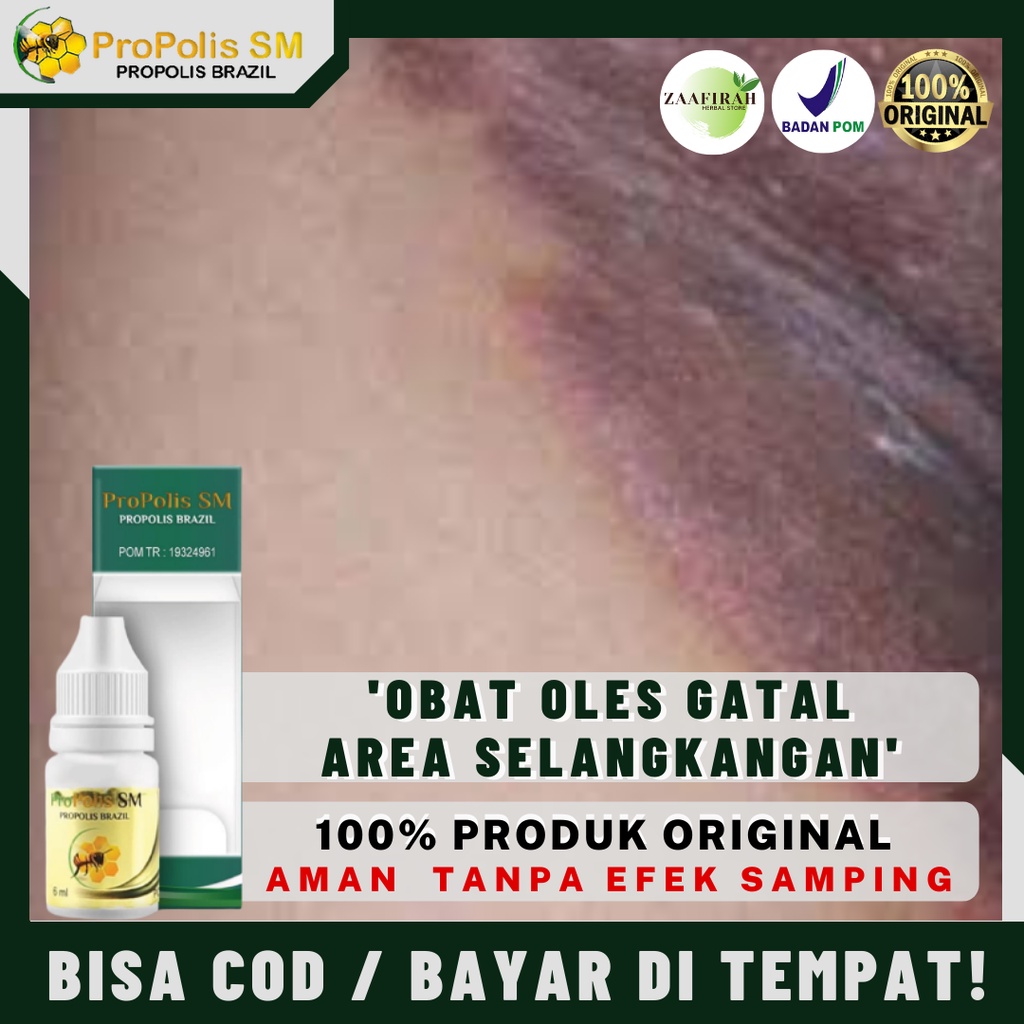 Obat Gatal Selangkangan - Obat Selangkangan Hitam - Obat Selangkangan Berjamur - Obat Gatal Di Pangk