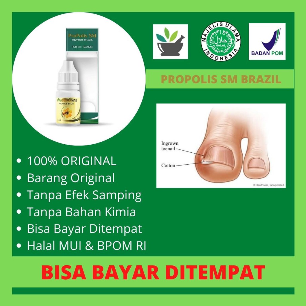 Obat Tetes Untuk Kuku Kaki Centangan - Kuku Kaki Centangan - Warna Berubah Hitam /PROPOLIS SM BRAZIL