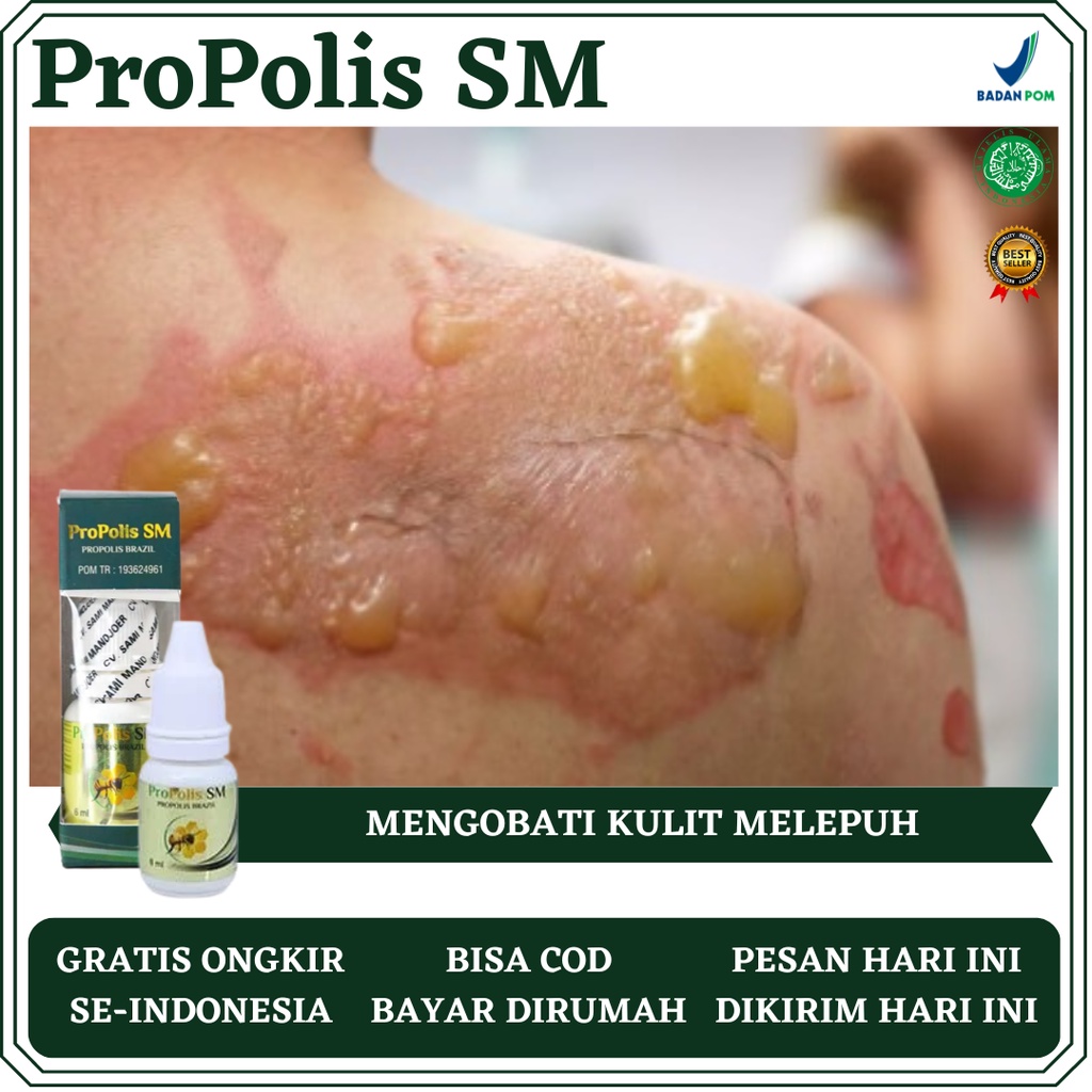 Obat Luka Bakar, Obat Kulit Melepuh, Obat Luka Bakar Melepuh, Obat Luka Air Panas, Obat Luka Cepat K