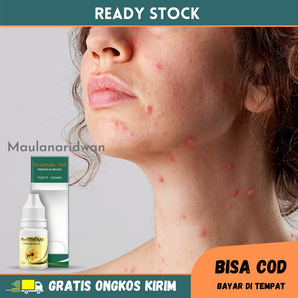 Obat Cacar Air, Campak, Herpes, Cacar Air Di Wajah, Cacar Api, Obat Gatal Cacar Air - Propolis SM