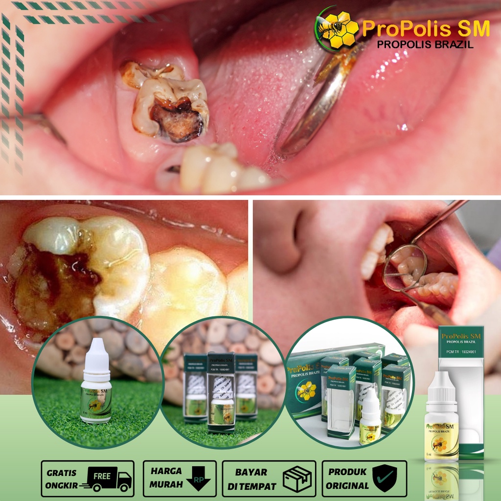 Obat Gigi Berlubang, Obat Pembersih Gigi Berlubang, Obat Gigi Berlubang Agar Cepat Copot, Obat Sakit