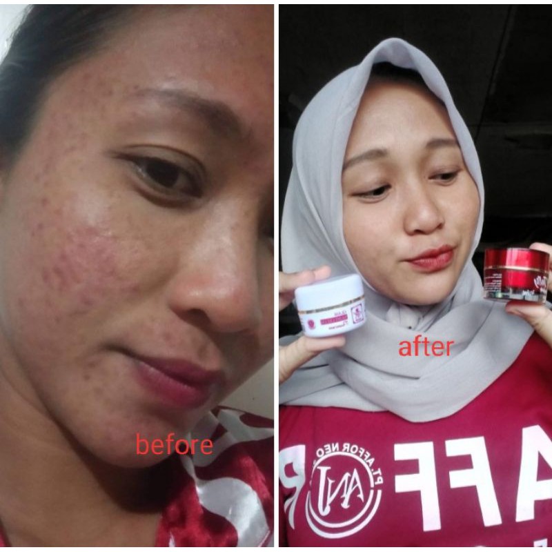 COD - RK GLOW ACNE - PAKET SKINCARE JERAWAT - MENGHILANGKAN ACNE DAN BEKASNYA - MEMBUAT MULUS