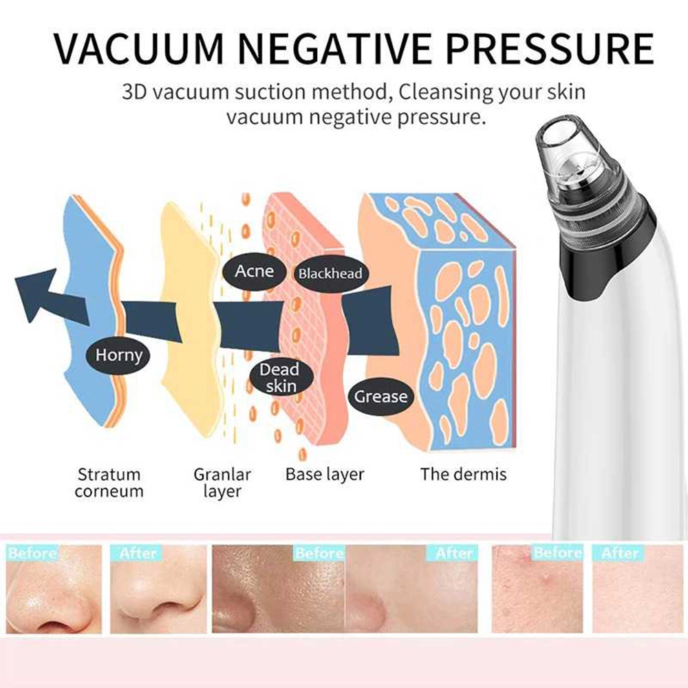 Alat Penghisap Sedot Komedo Vacuum Suction Blackhead Pore Facial Care