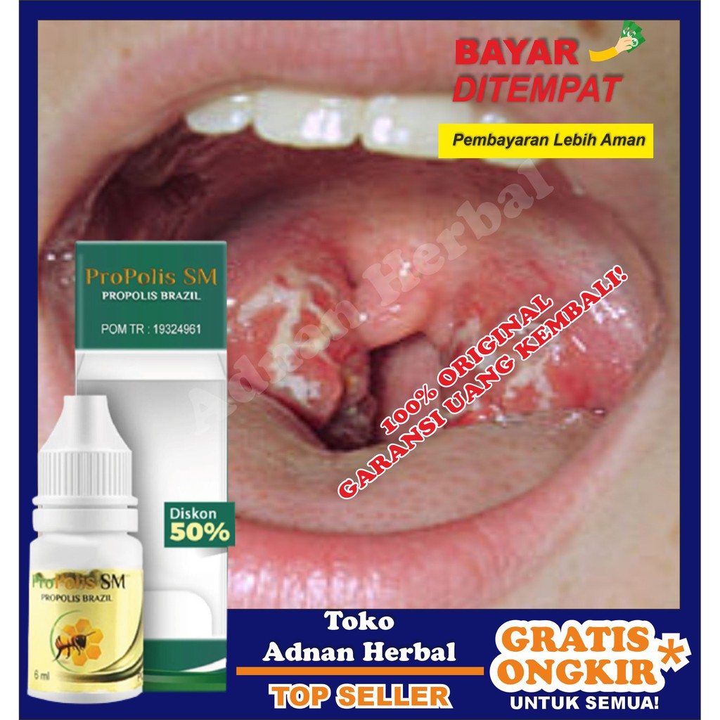 Obat Herbal Amandel, Amandel Bengkak, Radang Amandel & Alami
