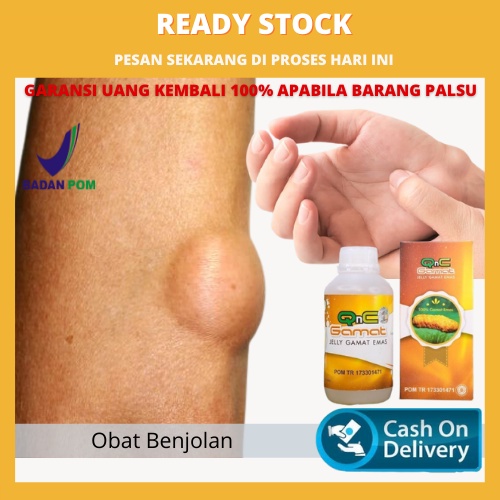 Obat Benjolan Alami ,Obat Benjolan Di Tangan, Kepala, Punggung, Tubuh, Obat Ngilangin Benjolan Qnc J