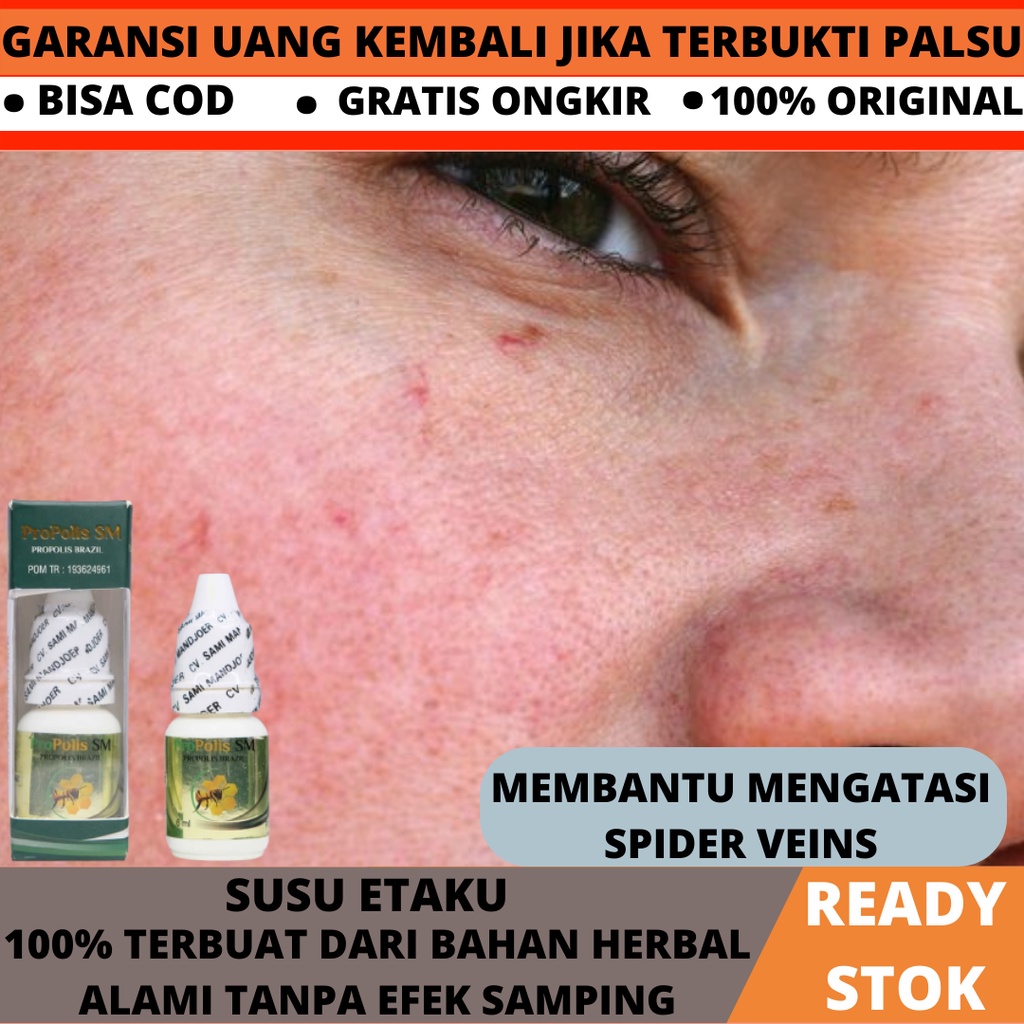 Obat Oles Penghilang Spider Veins Original BPOM, Obat Herbal Penghilang Urat Halus Di Wajah (spider 