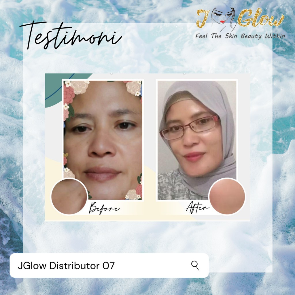 JGLOW Flek Melasma Hyperpigmentasi | Paket Perawatan Wajah Skincare BPOM-2
