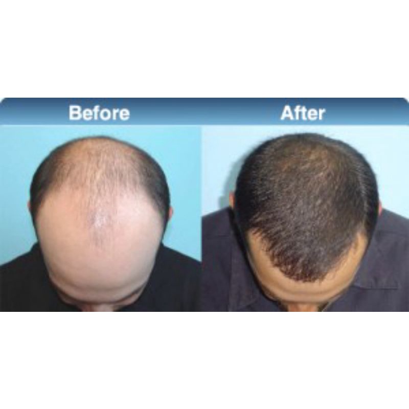 Penumbuh rambut botak dan rontok penumbuh rambut cepat pria wanita