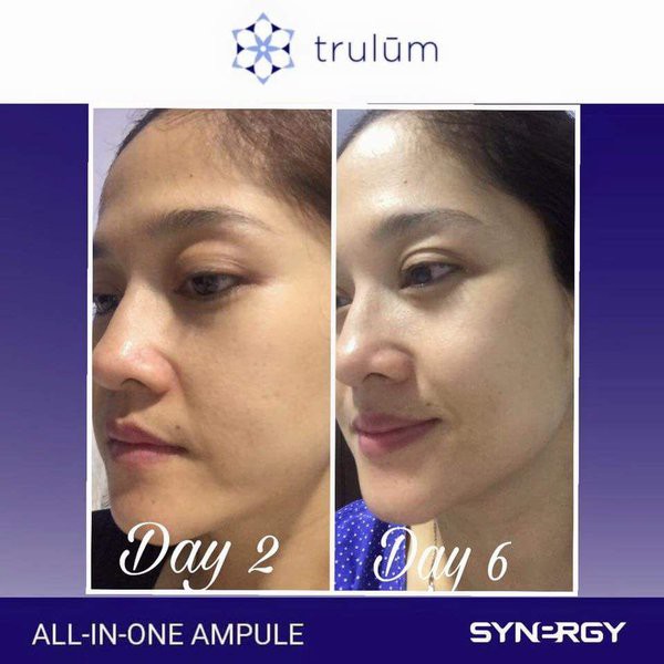 

Promo Krim Instant Glowing Atasi Bopeng Bekas Jerawat Untuk Kulit Asia terlaris