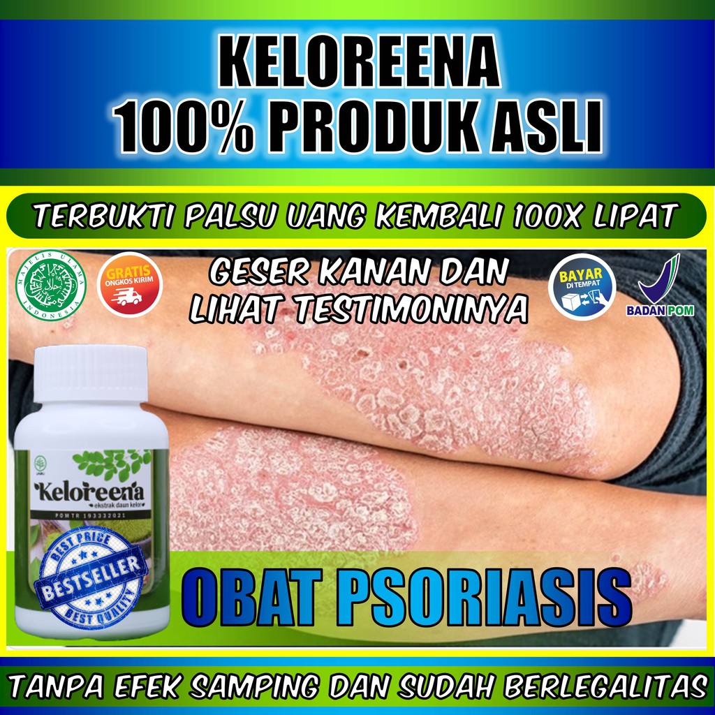 Obat Psoriasis Kulit Kepala Kulit Kepala Gatal Berkerak Kulit Kepala Kering dan Bersisik Obat Kulit 
