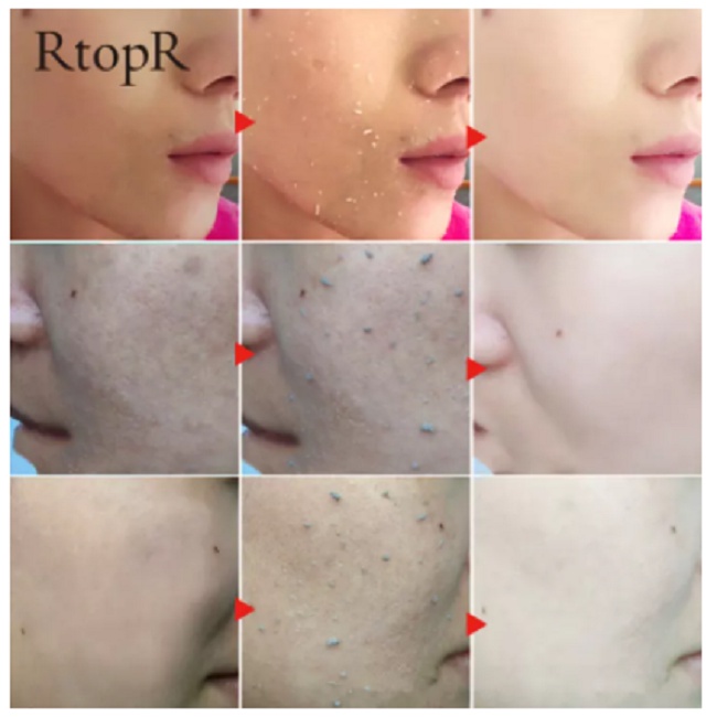 REMOVE DEAD SKIN CARE RTOPR EXFOLIATING