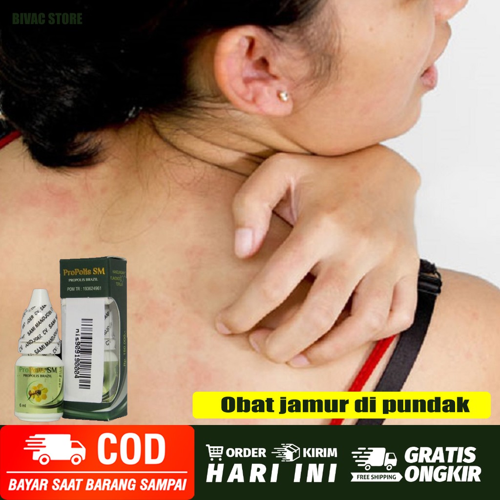 

obat jamur di kulit - jamur di selangkangan - jamur di tangan - jamur di pundak dan area badan lain