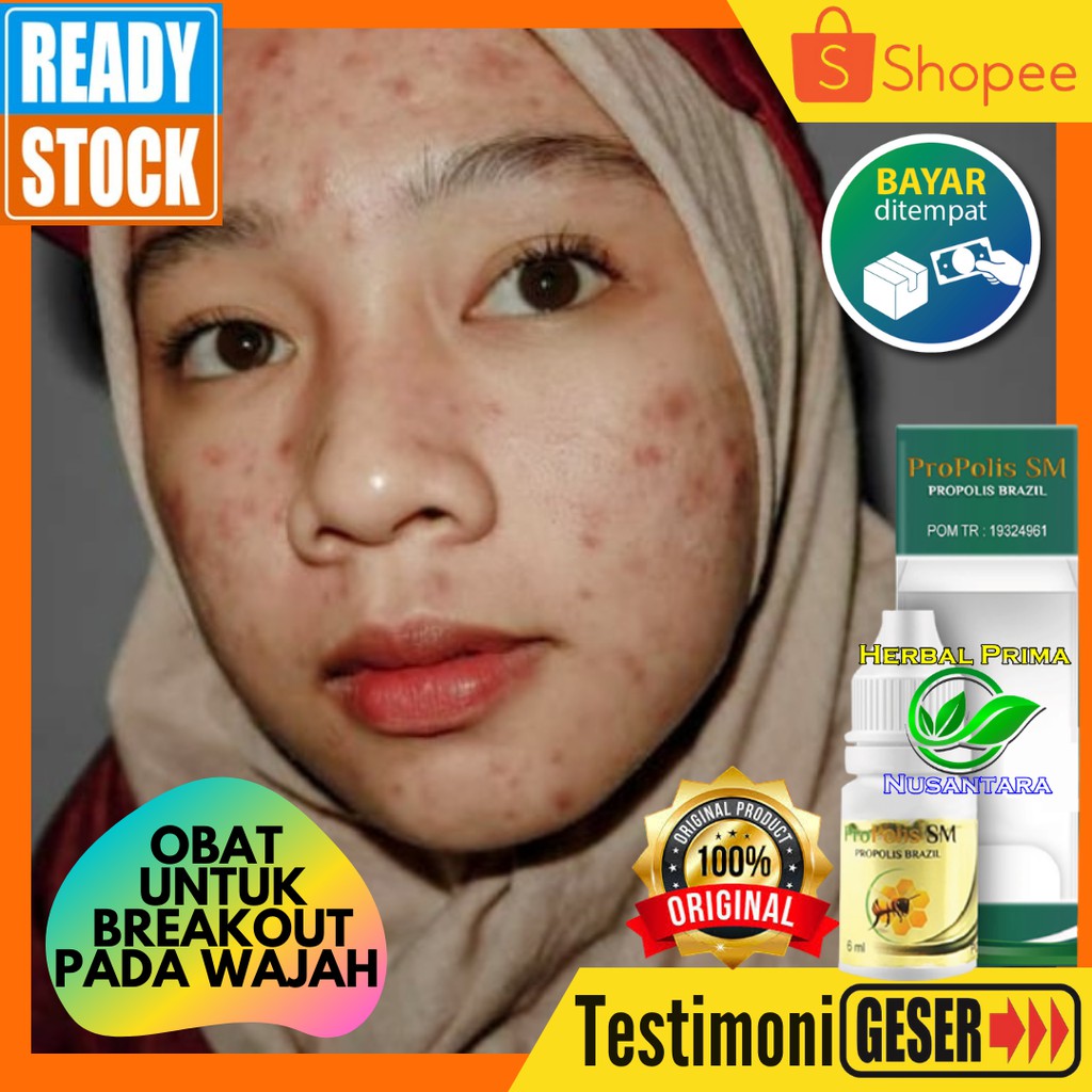 Obat Breakout Pada Wajah Breakout Bruntusan Kulit Wajah Iritasi Dan Berjerawat Shopee Indonesia